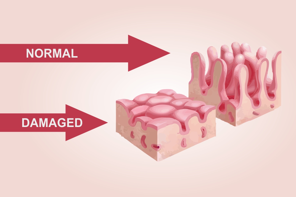 Celiac/Coeliac Damaged Villi